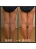 【痩身エステ】【脚スリム】ふくらはぎ＆太もも後ろ　4回29,800円