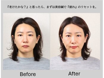 中目黒ゆう鍼灸 整骨院/before/after/中目黒/美容鍼