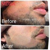 エムディーエスエー(MDSA)