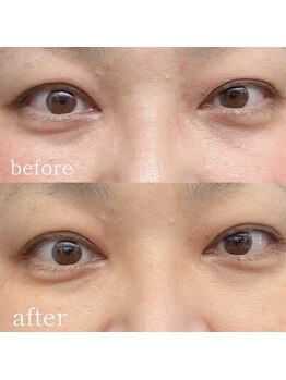 シーズボーテ(C's Beaute)/目元のハリケア|レッドショット