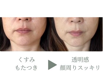 たるみアガル(たるみagaru)/くすみ・もたつきの変化｜更年期