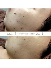 サロン ピューパ(Salon pupa)/ハーブピーリングBefore→After