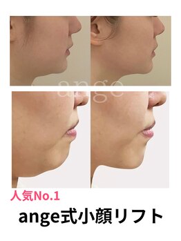 アンジェ(ange)/ange式小顔リフト