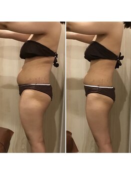 カンフリエ 吉野ヶ里店(Camphrier)/【痩身】ビフォーアフターご紹介