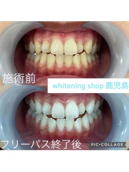ホワイトニングショップ 鹿児島店/#鹿児島ホワイトニング