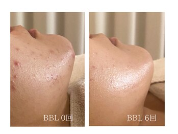 エモベーシック(e'MO BASIC)/光美容の王様BBLニキビ専用ケア