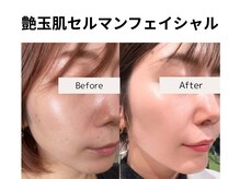 フェイスプラスリフ(FACE+RiF)