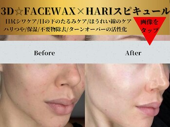 ベルアンドヘルス 千葉(BELL&HEALTH)/FACEWAX×HARIスピキュール