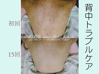 ウィズマツオカ 光の森店/和漢背中トラブルザラザラ