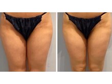 ルナグランデ(Luna grande.)/太ももの隙間作りは当店へ♪