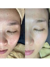 ミーミー 多治見店(MeMe.)/毛穴エクストラクション