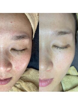 ミーミー 多治見店(MeMe.)/毛穴エクストラクション