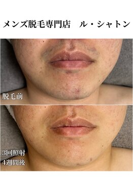 ルシャトン(Le Chaton)/ヒゲ脱毛