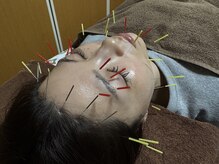 カラー(Calla)/美容鍼フルコース