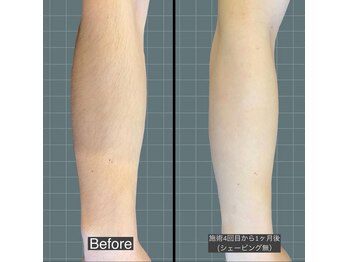 アレッド 大阪店(ared.)/腕脱毛！