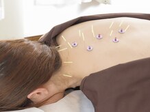 こころ晴れ鍼灸院/自律神経の乱れを整えて不眠改善