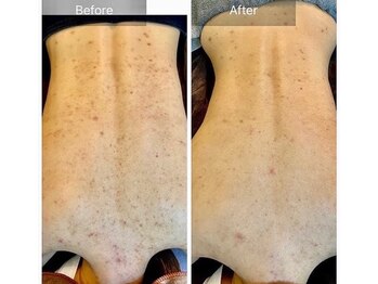 エミルカ 千葉店(EMILUCA)/ハーブピーリング/背中ニキビ