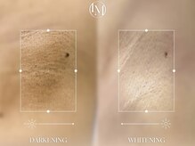 エモーショナル 姫路(Emotional)/ルメラ◎ワキの黒ずみ