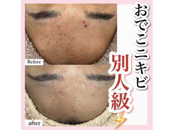 ホワイトアクア 天王寺本店(WHITE AQUA)/ハーブピーリング/大阪/天王寺