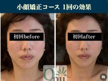 キュープ 表参道店(Qpu)/継続が「小顔」と「美」をつくる