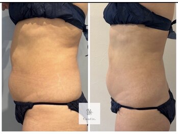 ミセルビューティー 御堂筋本町(micell beauty)/脂肪分解