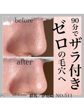 ナンバー511(No.511)/毛穴エステでザラ付ゼロへ