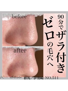 ナンバー511(No.511)/毛穴エステでザラ付ゼロへ