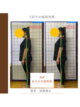 あらかき接骨院/【姿勢の変化】