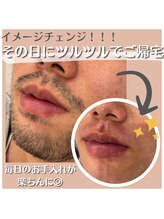 アート 熊本並木坂店(ART)/フラッシュワックス脱毛/ヒゲ