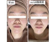 ホワイトアクア 岐阜店(WHITE AQUA)/ハーブピーリング/岐阜/ニキビ