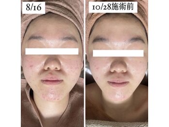 ホワイトアクア 岐阜店(WHITE AQUA)/ハーブピーリング/岐阜/ニキビ