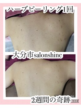 サロンシャイン(Salon Shine)/ハーブピーリングハード1回