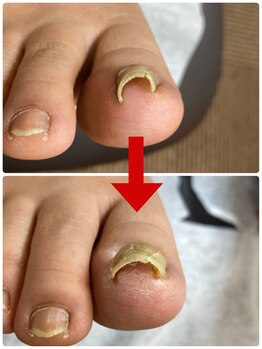 一宮巻き爪センター/巻き爪