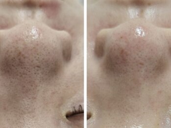 カヌヌ(kanunu)/毛穴洗浄/ハーブピーリング