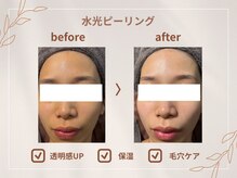シロ(CHILO)/水光ピーリング