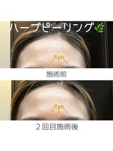 サクラ(Sakura)/剥離なしハーブピーリング