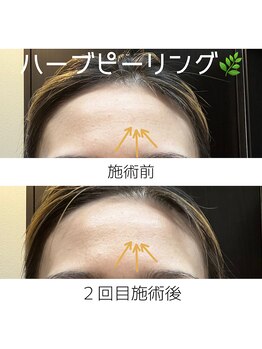 サクラ(Sakura)/剥離なしハーブピーリング