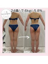 シーディーエム(cdm)/イヤーセラミック3ヶ月後