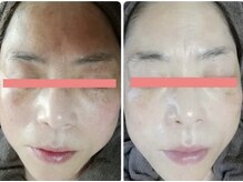 サロンドミジュ(Salon de 美jyu)/最高品質ヒト幹細胞培養液導入