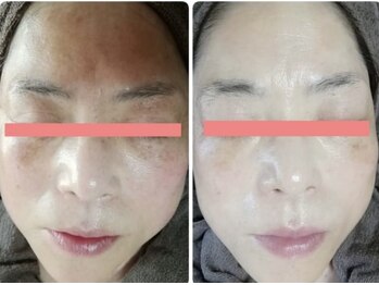 サロンドミジュ(Salon de 美jyu)/最高品質ヒト幹細胞培養液導入