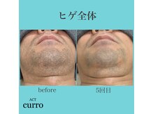 アクト クロ(ACT curro)/【ヒゲ全体】脱毛施術例