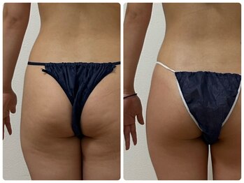 カレン(KAREN)/セルゼロ×脂肪燃焼#ヒップ