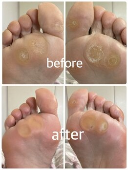 フロー(Froh)/大きなタコ　ウオノメ