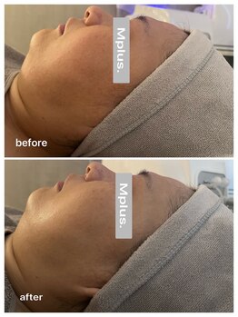 エムプラス(Mplus.)/スリムフェイスカッター♪