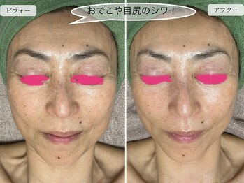 スローガーデン(Slow Garden)/炭酸パックビフォーアフター