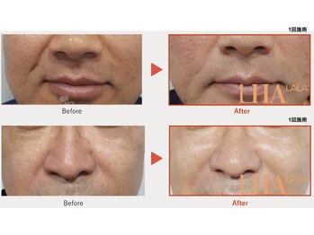 ピオラ(Piora)/ララピール/1回での効果