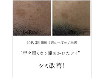 シミリセット 名駅(シミReset)/ボタンの様なシミ・改善