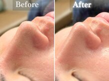 ボーンオム(Born Homme)/毛穴洗浄＋美容液導入：30代女性