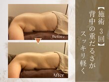 アロナプラス(Arona+)/施術3回