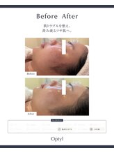 芯美 恵比寿店(shinbi)/オプティル*LDM水玉リフティング